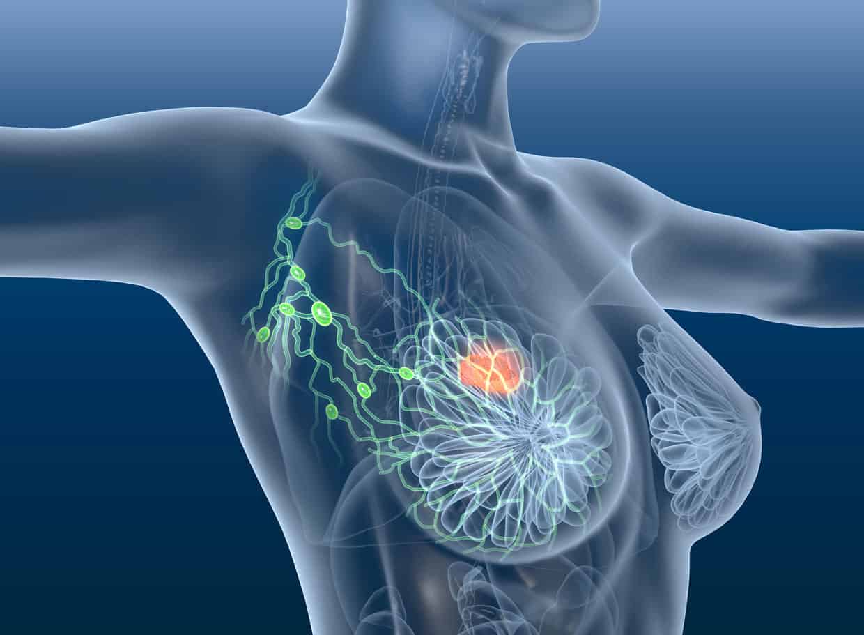 Breast Cancer: A Female Naturopath's Perspective